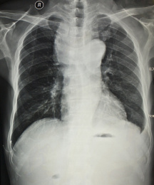 放射科医学影像胸部正位胶片