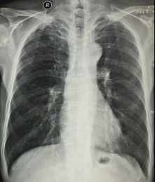 放射科医学影像胸部正位胶片