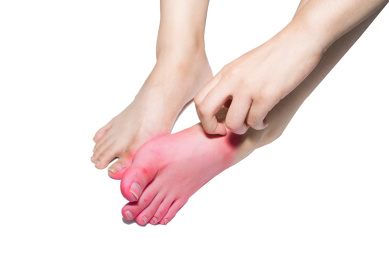 一个人脚部红肿痒痒正在挠痒痒疑似得了脚气香港脚灰指甲棚拍白色背景