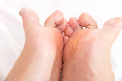 患脚气病的脚部特写