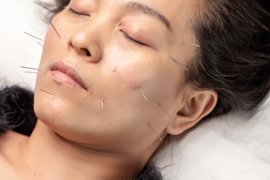 一个女人的面部针灸特写