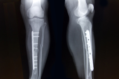 胫腓骨骨折钢板内固定术后X线摄影胶片