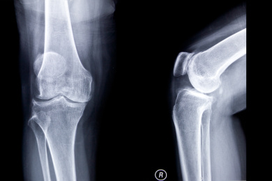 放射科数字DR胶片膝关节正侧位