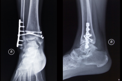 放射科数字DR胶片踝关节正侧位