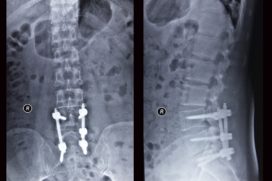放射科数字DR胶片腰椎正侧位