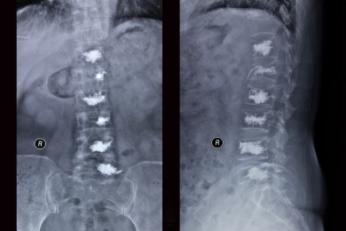 放射科数字DR胶片腰椎正侧位