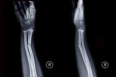 放射科X线摄影骨胳影像胶片