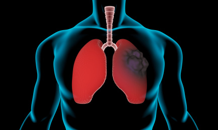 肺部肿瘤透视插图，癌症，肺癌