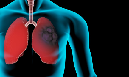 肺部肿瘤透视插图，癌症，肺癌