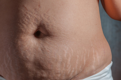 生完孩子后肚子上的妊娠纹