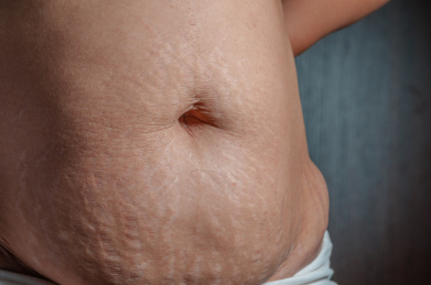 生完孩子后肚子上的妊娠纹