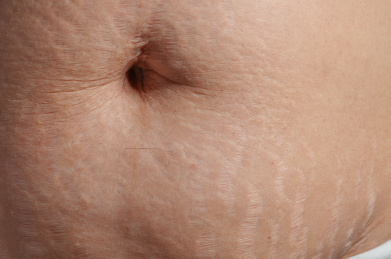 生完孩子后肚子上的妊娠纹