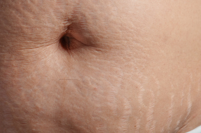 生完孩子后肚子上的妊娠纹