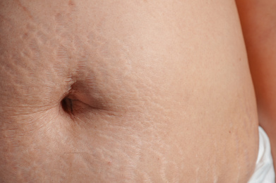 生完孩子后肚子上的妊娠纹