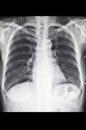 医院里数字放射DR和CT胶片影像图