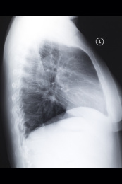 医院里数字放射DR和CT胶片影像图