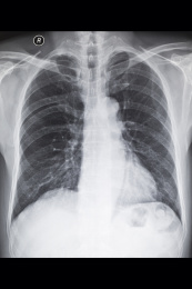 医院里数字放射DR和CT胶片影像图
