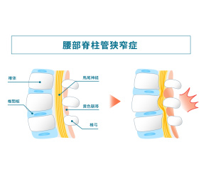 腰椎管狭窄症的说明性图解