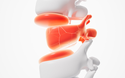 人类脊椎发炎肿胀治疗3D渲染