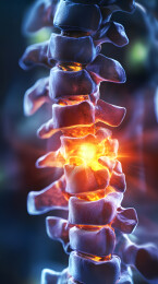 脊椎疼痛3D医学影像图