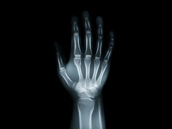 手部X光影像